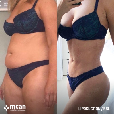 Actual MCAN Health patient: Liposuction Result - Photo 2