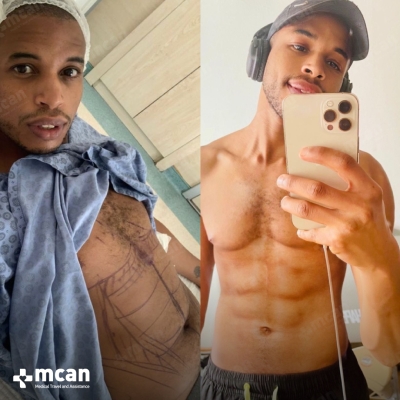 Actual MCAN Health patient: Liposuction Result