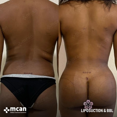 Actual MCAN Health patient: Liposuction Result