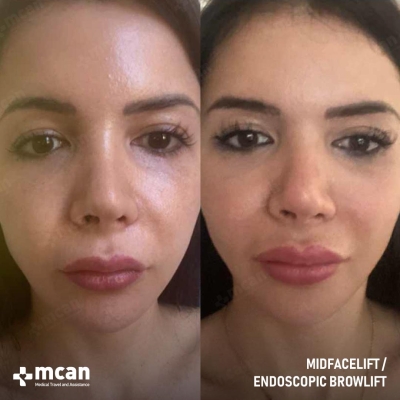 Actual MCAN Health patient: Mid Facelift Result