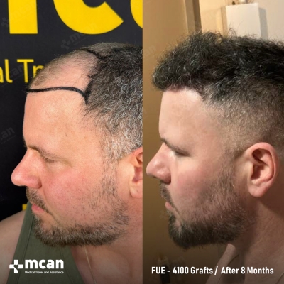 Actual MCAN Health patient: 4100 Grafts FUE Hair Transplant — 8 Months Result - Photo 2
