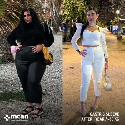 Actual MCAN Health patient: Gastric Sleeve Result