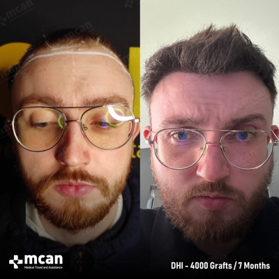 Actual MCAN Health patient: 4000 Grafts DHI Hair Transplant — 7 Months Result