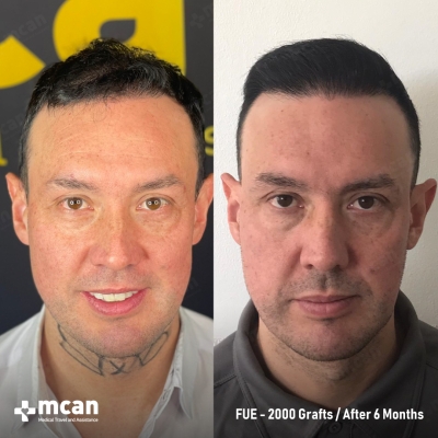 Actual MCAN Health patient: 2000 Grafts FUE Hair Transplant — 6 Months Result