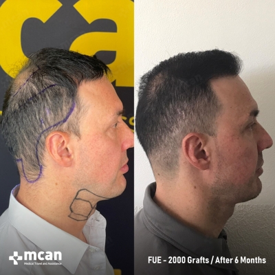 Actual MCAN Health patient: 2000 Grafts FUE Hair Transplant — 6 Months Result - Photo 2