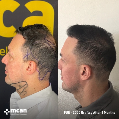 Actual MCAN Health patient: 2000 Grafts FUE Hair Transplant — 6 Months Result - Photo 3