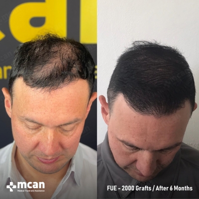 Actual MCAN Health patient: 2000 Grafts FUE Hair Transplant — 6 Months Result - Photo 4