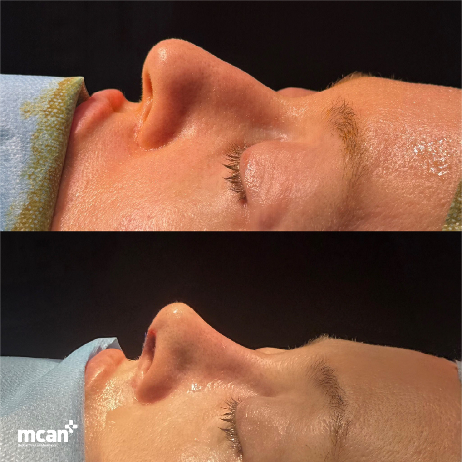 Rhinoplasty Decision Support in Turkey with MCAN Health
