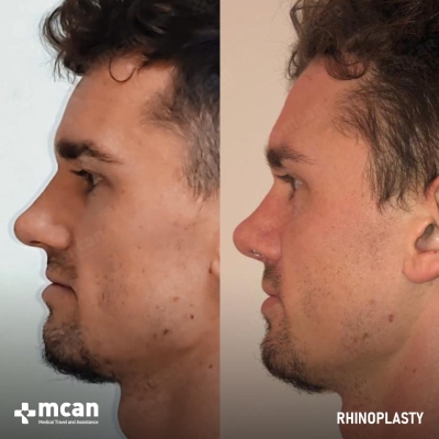 Actual MCAN Health patient: Rhinoplasty Result
