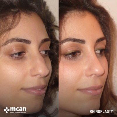 Actual MCAN Health patient: Rhinoplasty Result