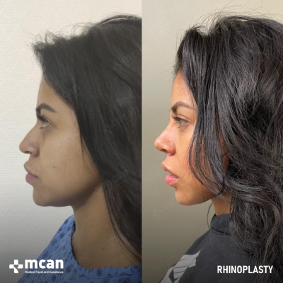 Actual MCAN Health patient: Rhinoplasty Result - Photo 2