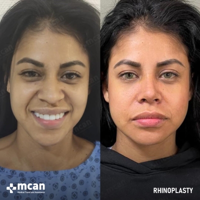 Actual MCAN Health patient: Rhinoplasty Result