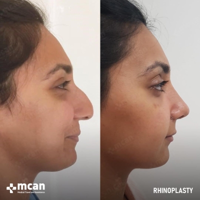 Actual MCAN Health patient: Rhinoplasty Result