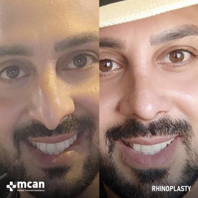 Actual MCAN Health patient: Rhinoplasty Result