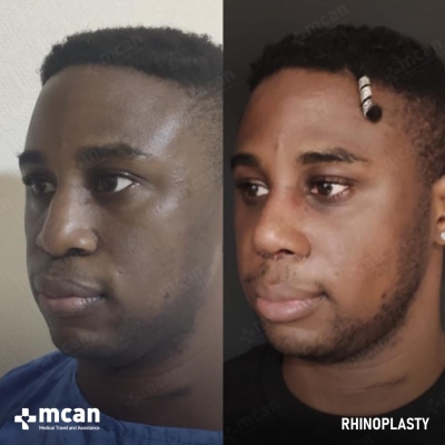Actual MCAN Health patient: Rhinoplasty Result