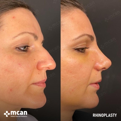 Actual MCAN Health patient: Rhinoplasty Result