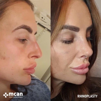 Actual MCAN Health patient: Rhinoplasty Result