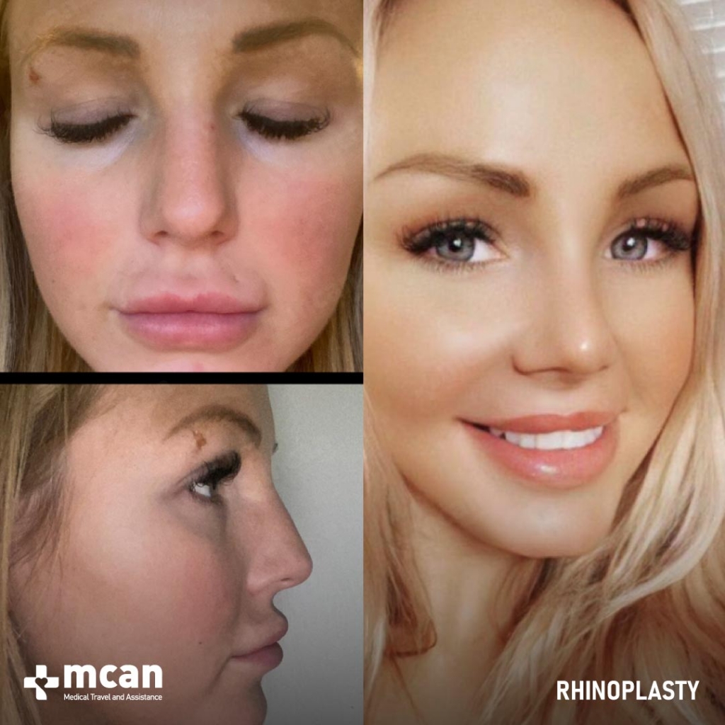 Rhinoplasty Nose Job Before After 25