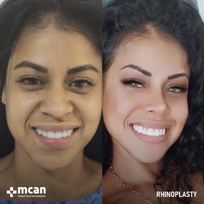 Actual MCAN Health patient: Rhinoplasty Result