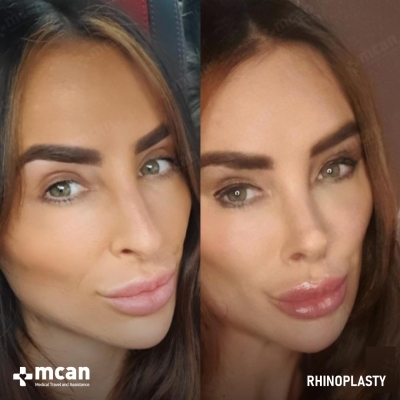 Actual MCAN Health patient: Rhinoplasty Result