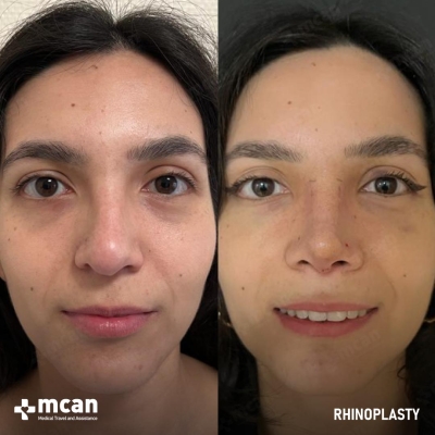 Actual MCAN Health patient: Rhinoplasty Result