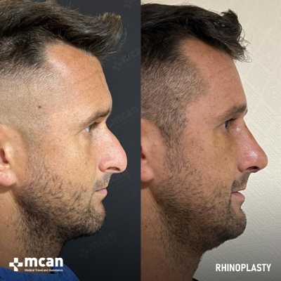 Actual MCAN Health patient: Rhinoplasty Result