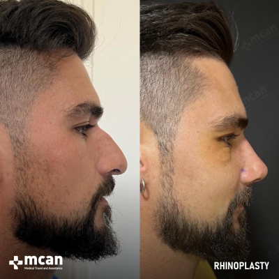 Actual MCAN Health patient: Rhinoplasty Result