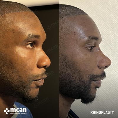 Actual MCAN Health patient: Rhinoplasty Result