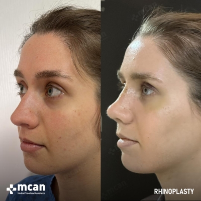 Actual MCAN Health patient: Rhinoplasty Result