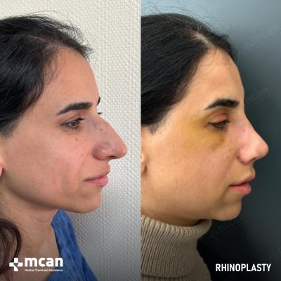 Actual MCAN Health patient: Rhinoplasty Result