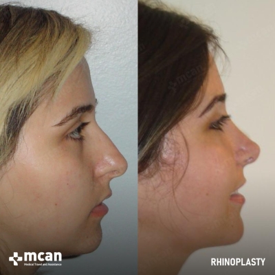Actual MCAN Health patient: Rhinoplasty Result
