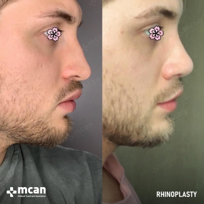 Actual MCAN Health patient: Rhinoplasty Result