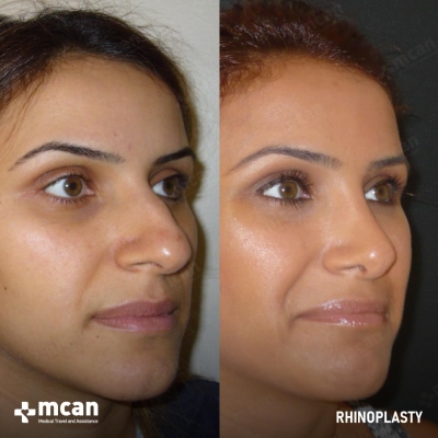 Actual MCAN Health patient: Rhinoplasty Result