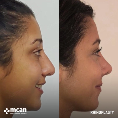 Actual MCAN Health patient: Rhinoplasty Result