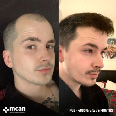 Actual MCAN Health patient: 4000 Grafts FUE Hair Transplant — 6 Months Result