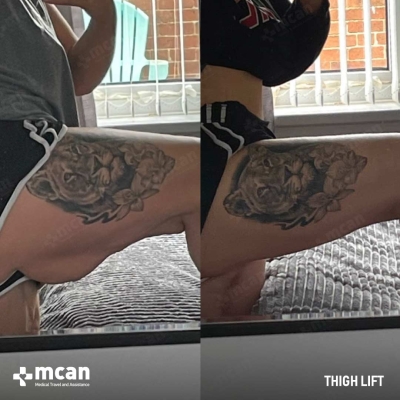 Actual MCAN Health patient: Thigh Lift Result