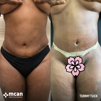 Actual MCAN Health patient: Tummy Tuck Result