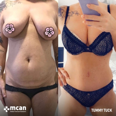 Actual MCAN Health patient: Tummy Tuck Result