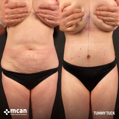 Actual MCAN Health patient: Tummy Tuck Result
