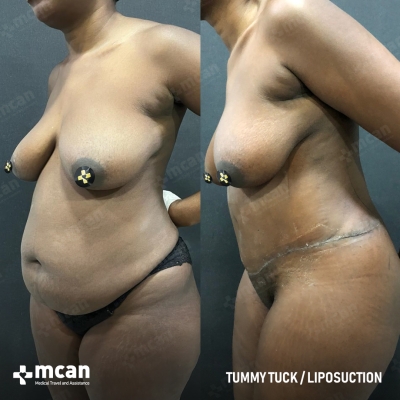 Actual MCAN Health patient: Tummy Tuck Result