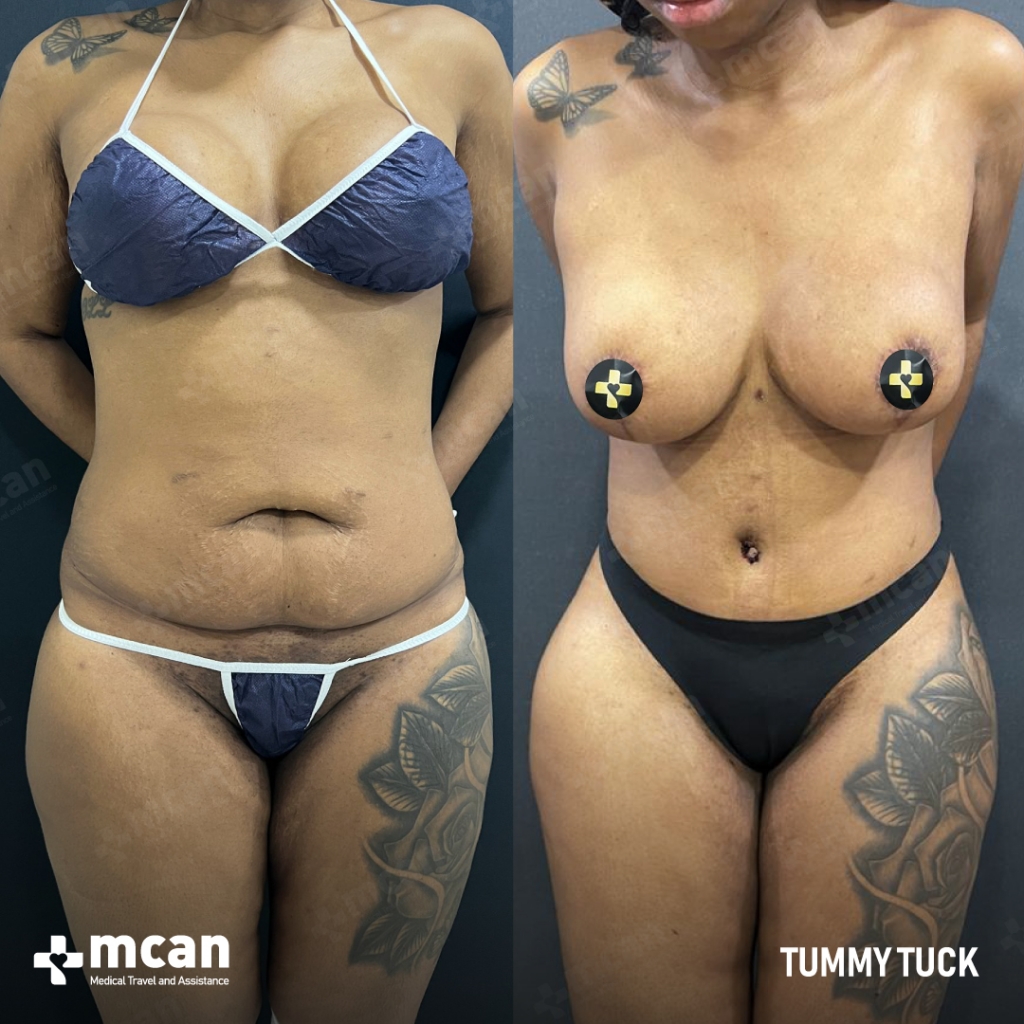 Tummy Tuck Before & After 3