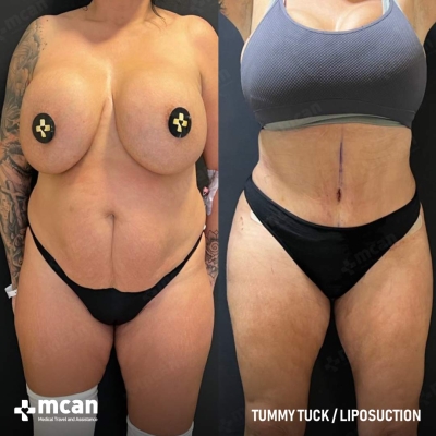 Actual MCAN Health patient: Tummy Tuck Result