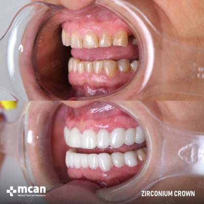 Actual MCAN Health patient: Zirconium Crown Result
