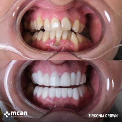 Actual MCAN Health patient: Zirconium Crown Result