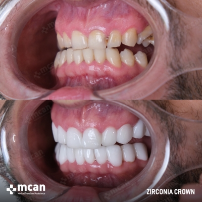 Actual MCAN Health patient: Zirconium Crown Result
