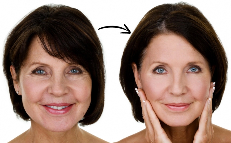 Full Facelift vs Lower Facelift: What is the Difference? 3 Full Facelift vs Lower Facelift 1 a blog about full facelift vs lower facelift