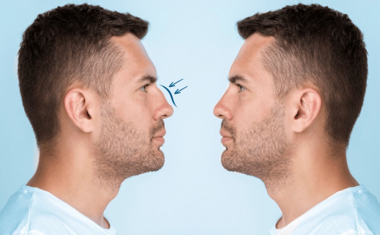 Rinoplastia Masculina: Preservar y Mejorar la Masculinidad 8 RINOPLASTIA MASCULINA un blog sobre rinoplastia masculina