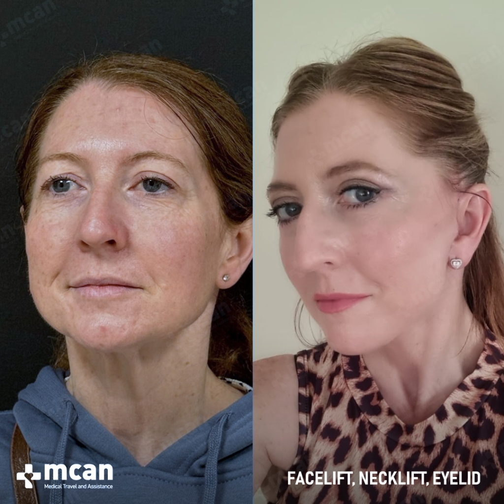 lifting facial antes y despues con mcan health 