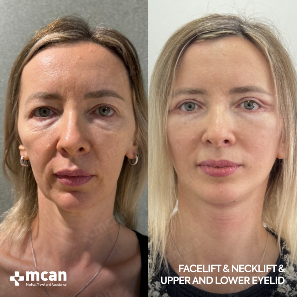 Lifting deep plane vs. SMAS: ¿qué técnica es la adecuada para usted? 7 FACELIFT BEFORE AFTER 9 FACELIFT BEFORE AFTER 9