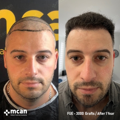 Actual MCAN Health patient: 3000 Grafts FUE Hair Transplant — 12 Months Result